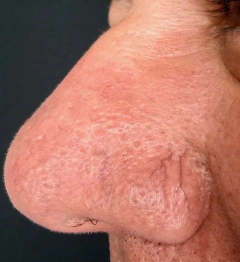 Facial Telangiectasis Treatment before treatment