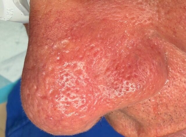 Facial Vein Removal after treatment