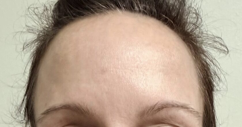 Frown Lines after treatment
