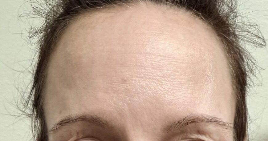 Forehead Lines after treatment