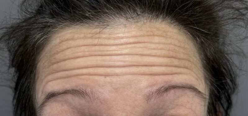 Frown Lines before treatment