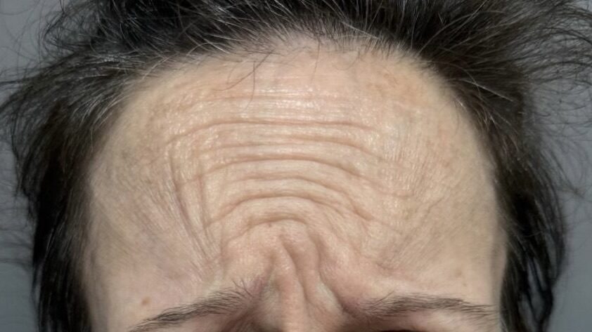 Forehead Lines before treatment