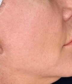 Exosomes Facial after treatment