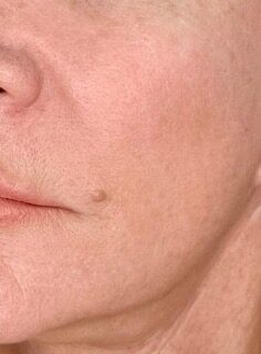 Exosomes Rejuvenation after treatment