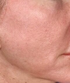 Exosomes Facial before treatment