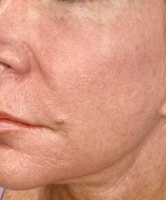 Exosomes Rejuvenation before treatment