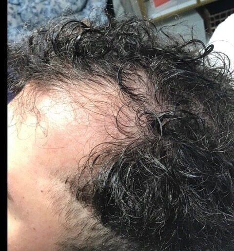 Hair Growth before treatment