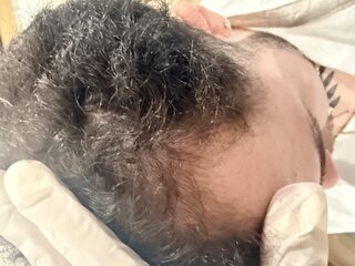 Hair Growth after treatment