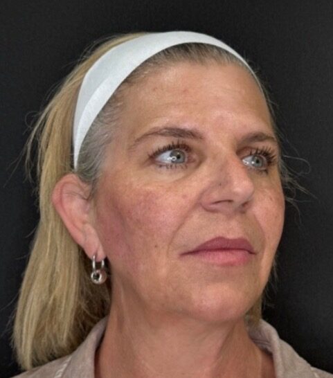 Cheek Enhancement after treatment