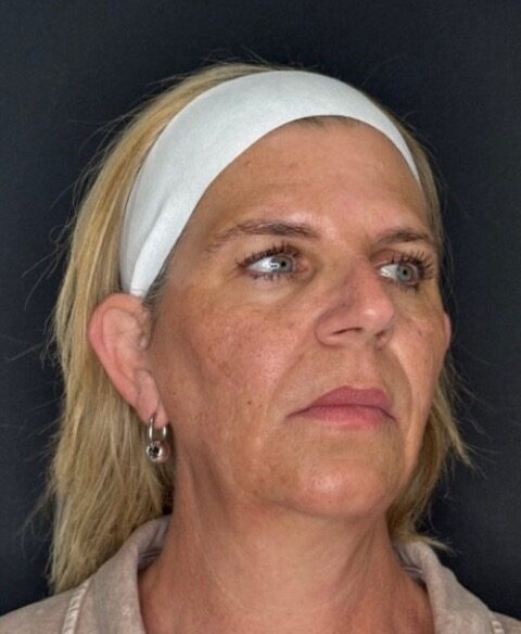 Cheek Enhancement before treatment