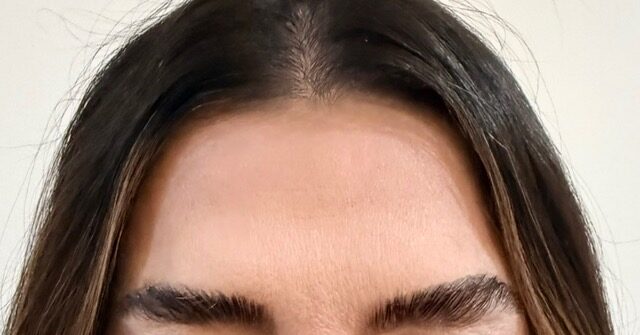 Forehead Smoothing after treatment