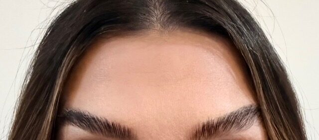 Frown Line Treatment after treatment
