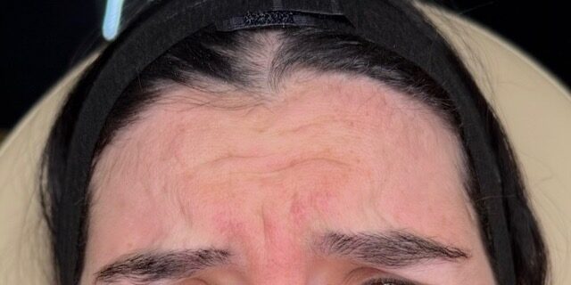 Forehead Smoothing before treatment