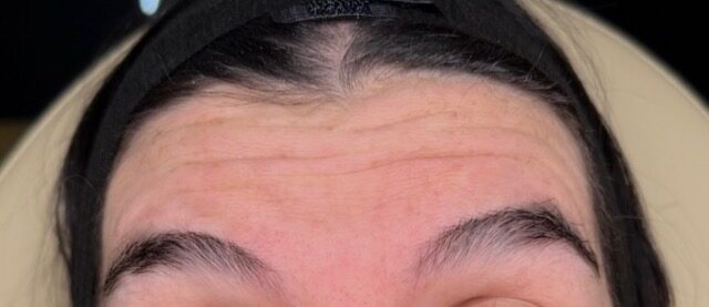 Frown Line Treatment before treatment