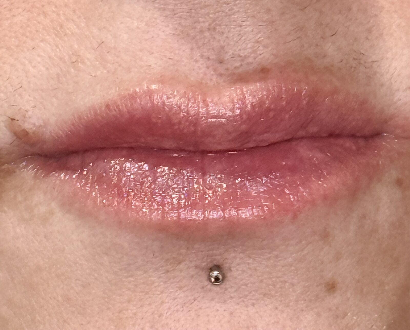 Lip Enhancement after treatment