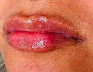 Lip Filler after treatment