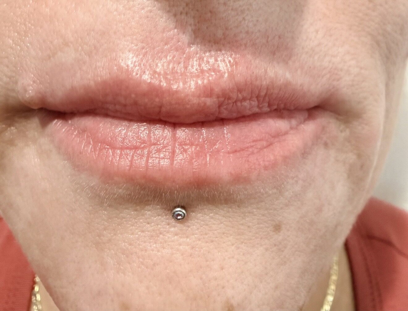Lip Enhancement before treatment
