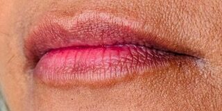 Lip Filler before treatment