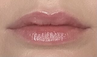 Lip Enhancement after treatment