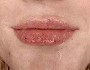 Lip Filler after treatment