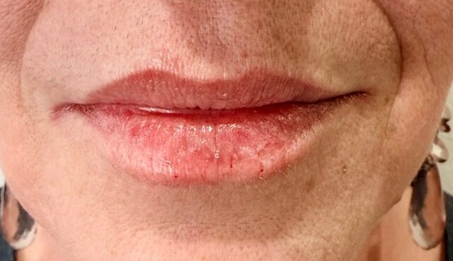 Lip Volume after treatment