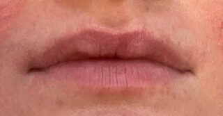 Lip Enhancement before treatment