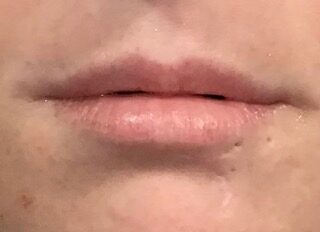 Lip Filler before treatment