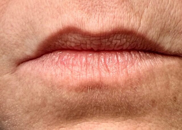 Lip Volume before treatment