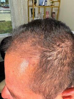 Facial PRP after treatment