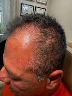 Facial PRP before treatment