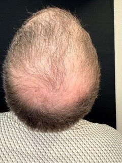 Hair Restoration after treatment
