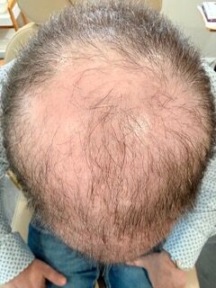 Hair Restoration before treatment