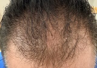 Scalp Treatment after treatment