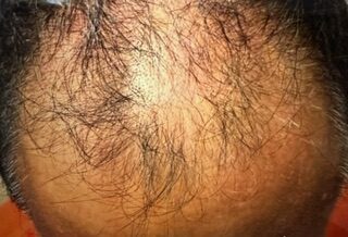 Scalp Treatment before treatment
